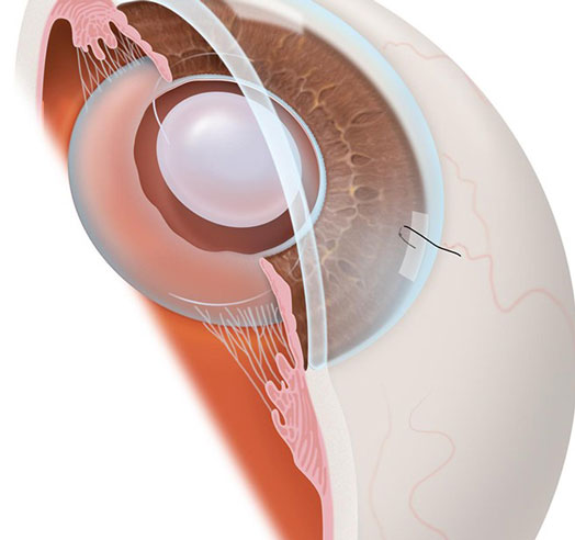 Intraocular Lens Implants