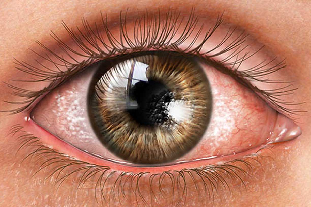 Dry Eye Syndrome