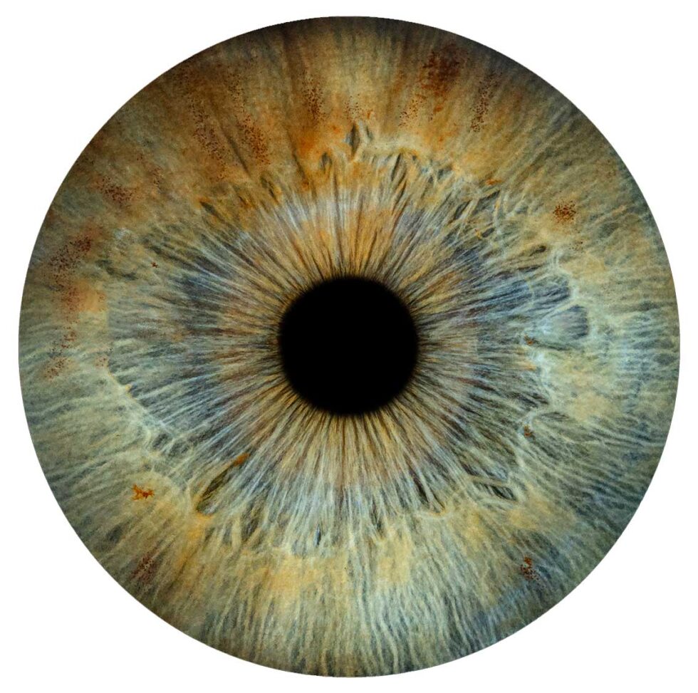 Close-up of a patient's eye