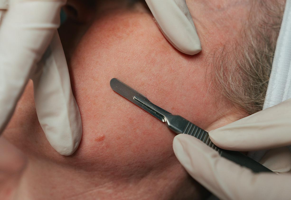 Dermaplaning is a fast, comfortable, and effective way to refresh your skin